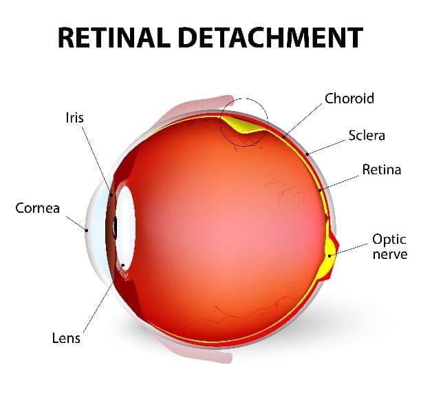Retinal Detachment - Vitreo-Retinal Consultants